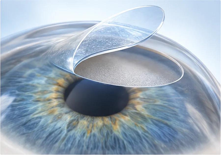 Ilustración conceptual de la córnea con el flap levantado, como en LASIK.